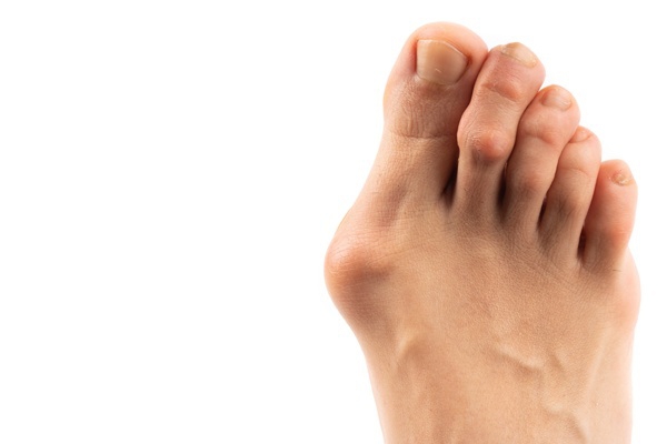 Bunions