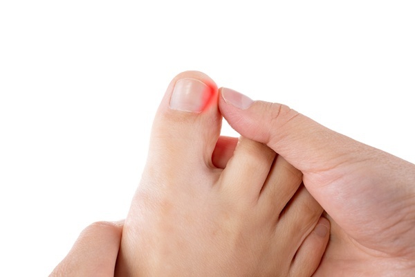 Ingrown Toenails