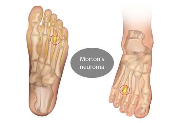 Neuromas