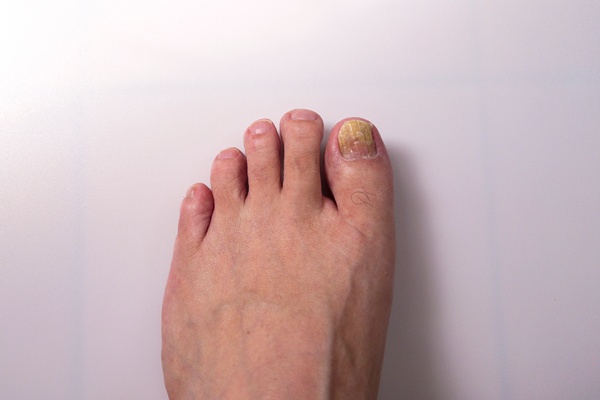 Toenail Fungus